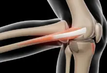 Cirurgia de LCA coloca parafuso