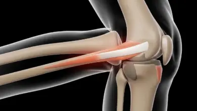 Cirurgia de LCA coloca parafuso