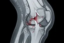Cirurgia de ligamento patelar