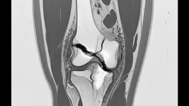 Cirurgia de patela com fios