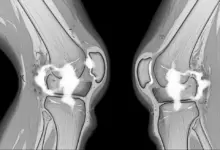 Edema periligamentar no joelho