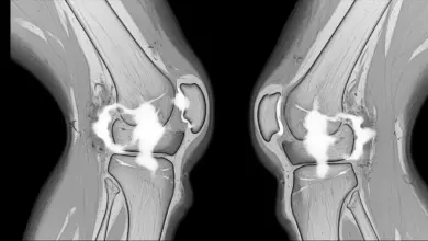 Edema periligamentar no joelho