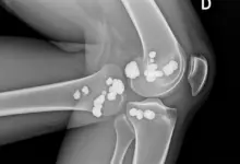 Entesopatia calcificada
