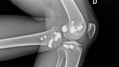 Entesopatia calcificada
