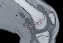 Entesopatia degenerativa no joelho