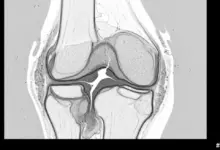 Erosão condral profunda