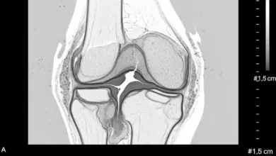 Erosão condral profunda