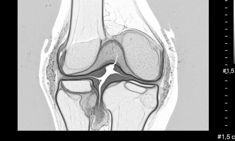 Erosão condral profunda