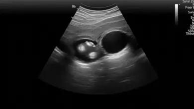 Espessamento sinovial no joelho