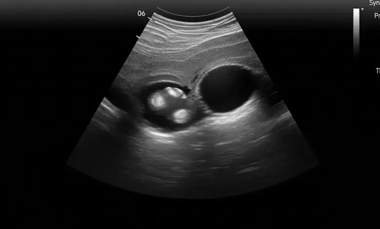 Espessamento sinovial no joelho