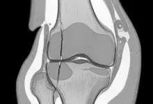 Fissura condral profunda na faceta medial da patela