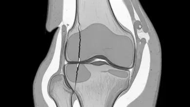 Fissura condral profunda na faceta medial da patela