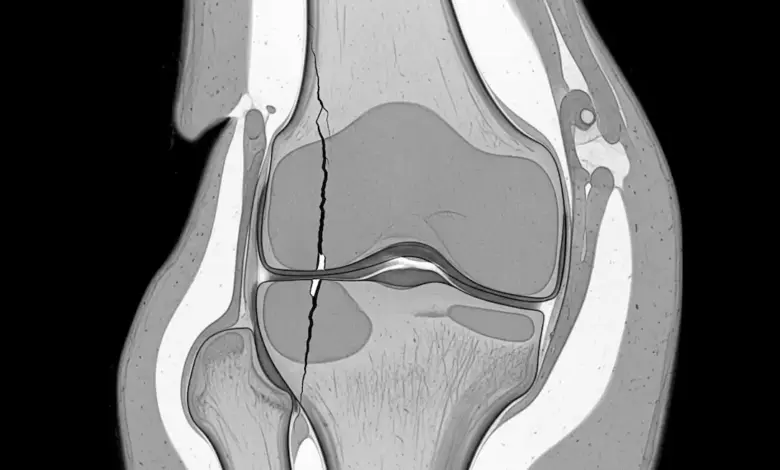 Fissura condral profunda na faceta medial da patela
