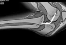 Meniscectomia parcial lateral