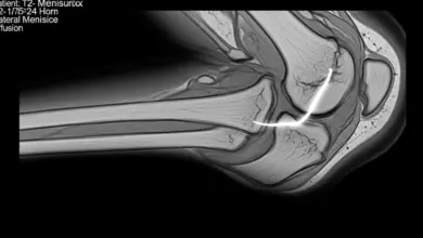 Meniscectomia parcial lateral
