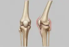 Osteotomia corretiva