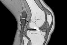 Síndrome da plica sinovial medial