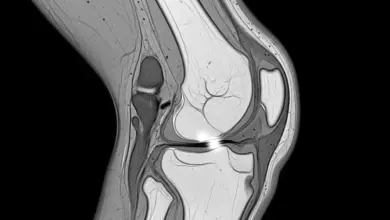Síndrome da plica sinovial medial