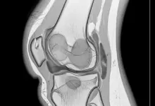 Sinovectomia parcial ou subtotal
