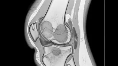 Sinovectomia parcial ou subtotal