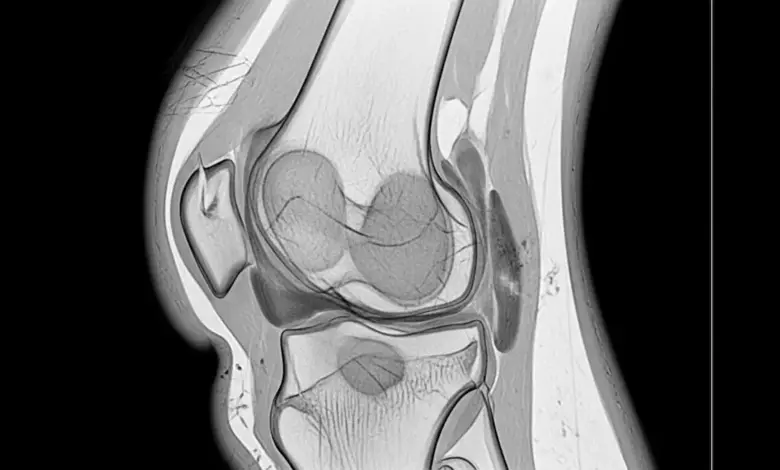 Sinovectomia parcial ou subtotal