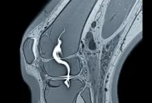 Tendão rompido volta ao normal
