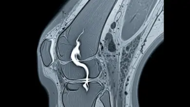 Tendão rompido volta ao normal
